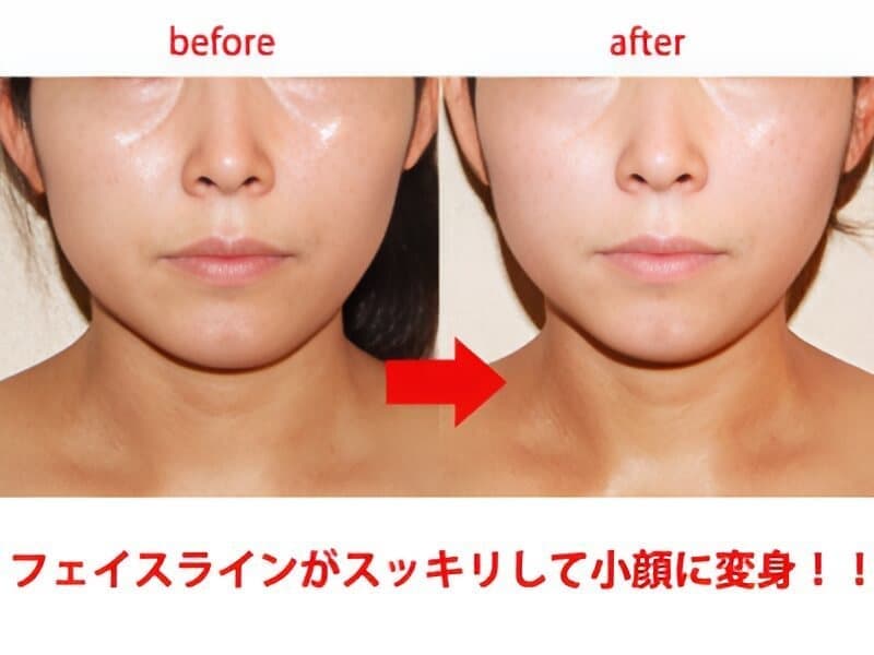 フェイス施術結果